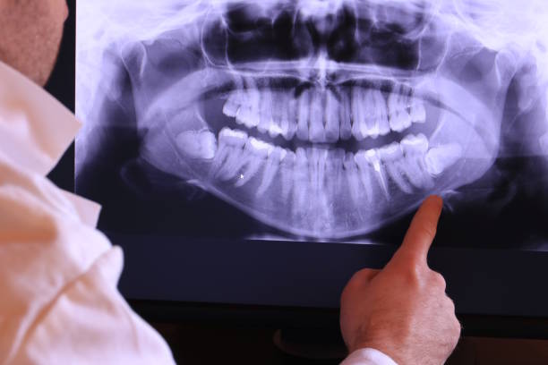Best Emergency Root Canal Treatment in Malone, FL